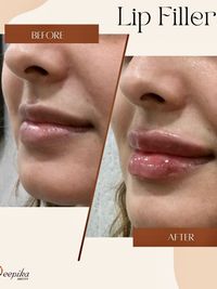 Anti-Aging & Facial Contouring