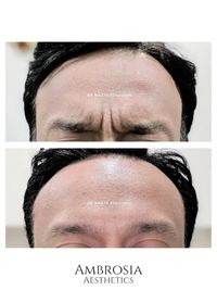 Anti-Aging & Facial Contouring