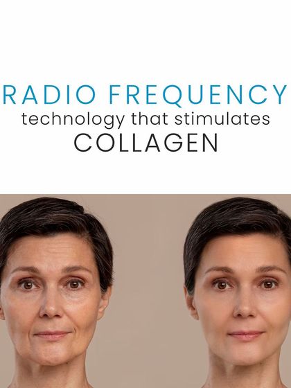 Thermage is a powerful non-surgical treatment that uses radiofrequency technology to stimulate collagen. This before-and-after shows the visible skin lifting and tightening effect after just one session.