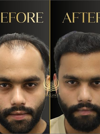 This before and after comparison is a testament to our work. We restored this patient's hairline and density, giving him a much more youthful and confident appearance.