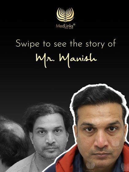 This collage tells the story of Mr. Manish, who came to us with Grade 6 baldness and left with renewed confidence.