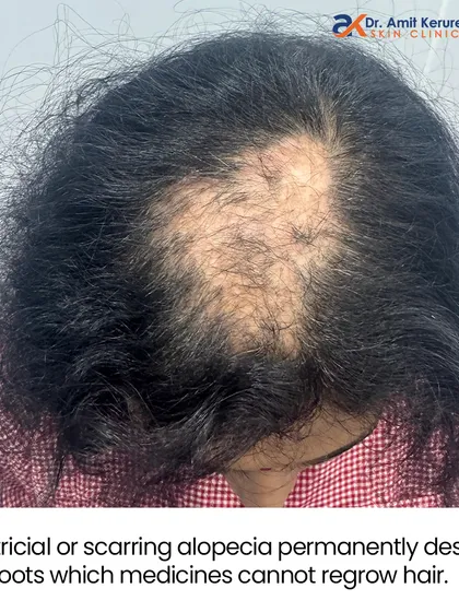 This image explains that cicatricial or scarring alopecia permanently destroys hair roots, which means medication alone cannot regrow hair. A hair transplant is the only viable option for restoration in such cases.