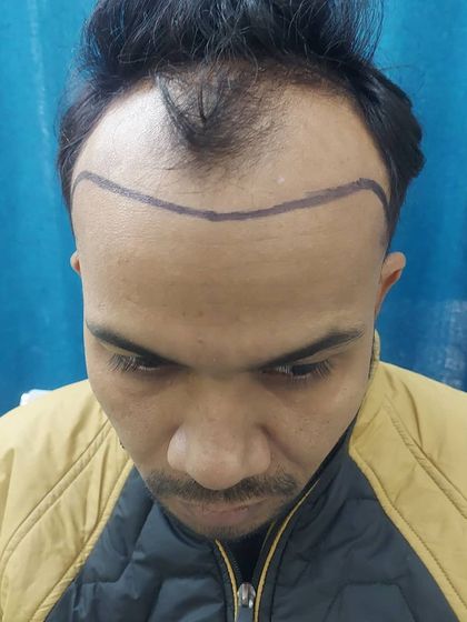The first step is designing a natural hairline. Here you can see the pre-operative markings that guide the entire transplant procedure, tailored to the patient's facial structure.