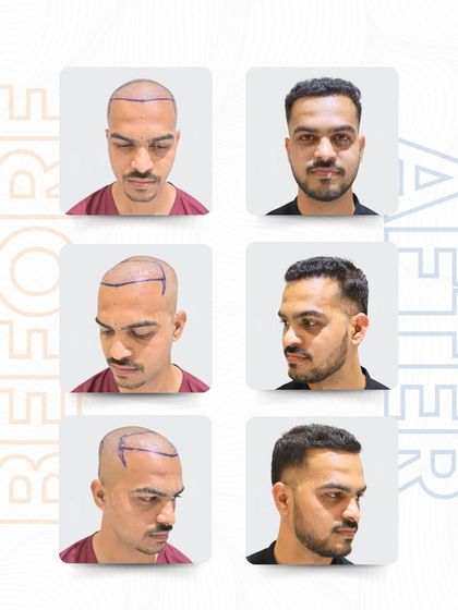 When Nilesh Shede came to me, I understood the insecurity he was fighting. With 1,987 grafts and my advanced RT-FUE technique, I restored natural density and gave him a result that matched how he wanted to see himself.