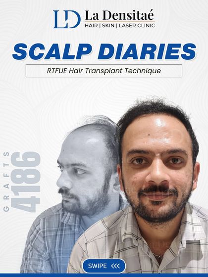 This image highlights Mr. Unmesh Thatte's journey, emphasizing the 4,186 grafts that rebuilt his hairline. It's a testament to how a detailed, technical approach leads to a natural, confident appearance.