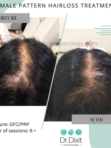 This is a powerful example of how a personalized treatment plan can make a significant difference. This patient was experiencing female pattern hair loss, and after a course of GFC and PRP sessions, we were able to achieve this significant increase in hair density and scalp coverage.