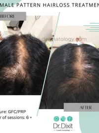 Hair Loss Treatment