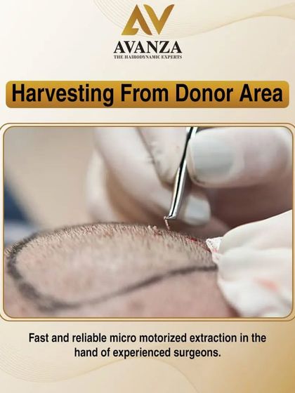 This image shows the harvesting of follicles from the donor area. We use a reliable micro-motorized extraction tool, which in the hands of our experienced surgeons, is fast and minimizes trauma to the scalp.