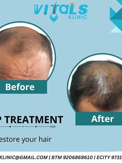 Vitals Klinic - Hair Restoration & Treatment Non-Surgical Hair Regrowth: PRP & GFC Therapy photo 4