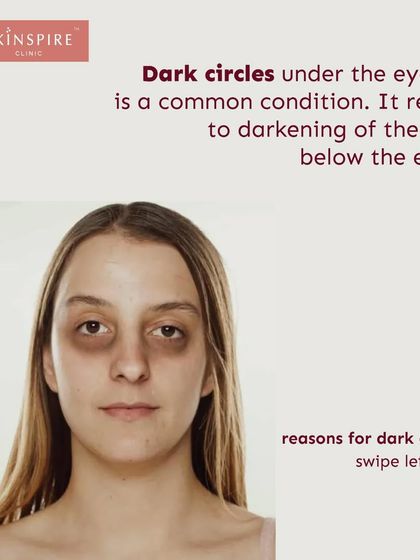 A clear and simple explanation of what dark circles are. This condition refers to the darkening of the skin under the eyes and can make one appear tired.