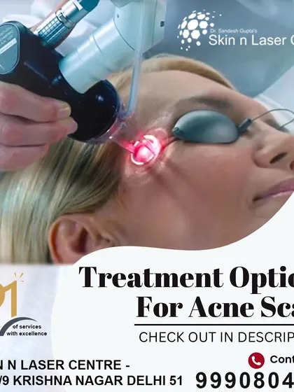 This graphic outlines the various treatment options we offer for acne scars. From laser resurfacing and chemical peels to microneedling and subcision, we create a personalized plan for your specific scar type.