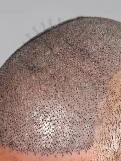 Immediate post-surgery view of a Norwood Grade 5A transformation. 5000 grafts were used to recreate the hairline and restore the frontal and mid-scalp regions.