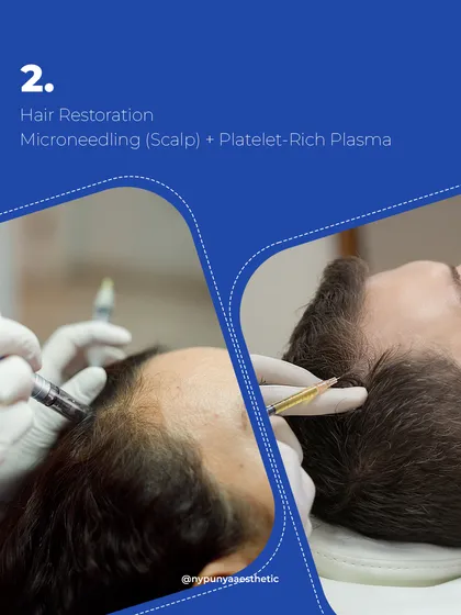 This is a glimpse into our Platelet-Rich Plasma (PRP) treatment. We combine microneedling with the application of PRP to the scalp. This process creates micro-channels that help the growth factors penetrate deeper, stimulating dormant hair follicles and improving blood circulation for better hair density and health.