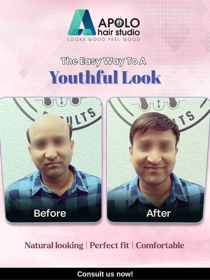 A youthful look is easily achievable with our services. This before-and-after comparison shows a client who regained a full head of hair with our comfortable, perfectly fitted, and natural-looking hair patch.