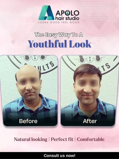 A youthful look is easily achievable with our services. This before-and-after comparison shows a client who regained a full head of hair with our comfortable, perfectly fitted, and natural-looking hair patch.