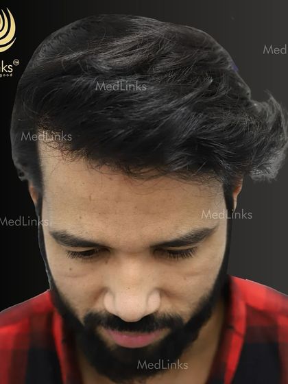 The top-down view after the transplant, showcasing the full coverage achieved.