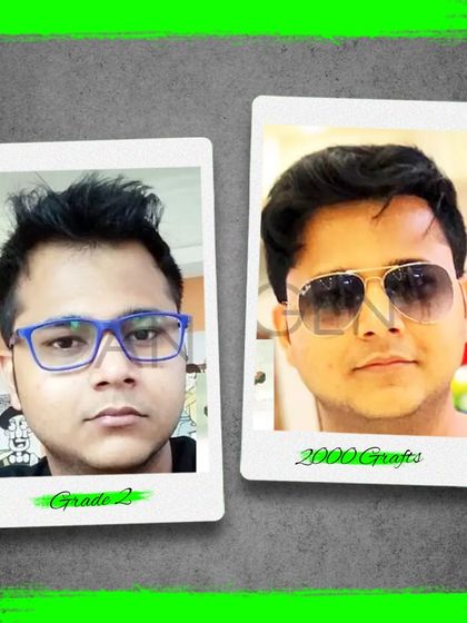 A real result from a patient with Grade 2 baldness who received 2000 grafts. Our techniques like Instant FUE and Sapphire FUE ensure a natural and dense hairline.