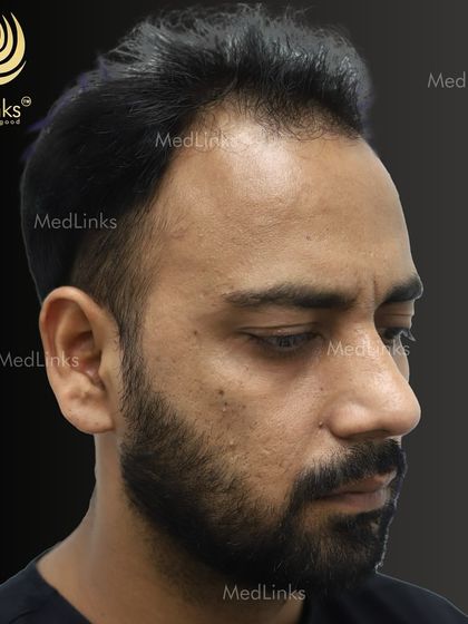The side profile before the procedure, showing the receding hairline.