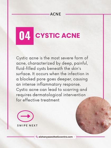 Cystic acne is the most severe form, characterized by deep, painful, fluid-filled cysts. This type of acne has a high risk of scarring and should always be treated by a medical professional.