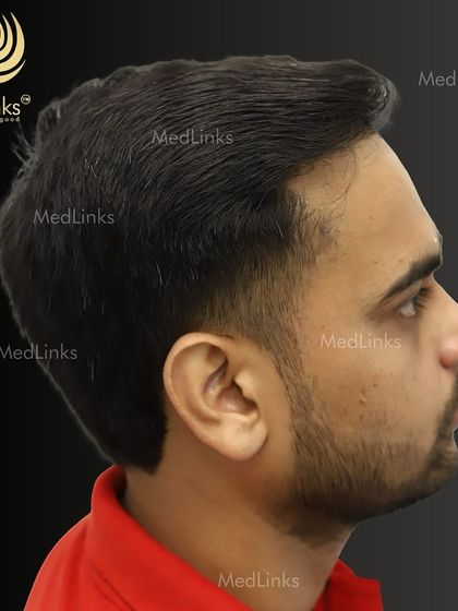 The final result from the side, showing a natural and dense hairline.