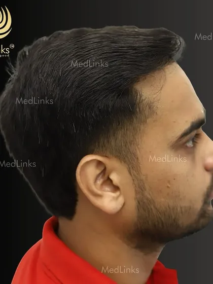 The final result from the side, showing a natural and dense hairline.