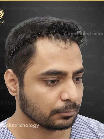 The patient's hair from the side before the procedure.