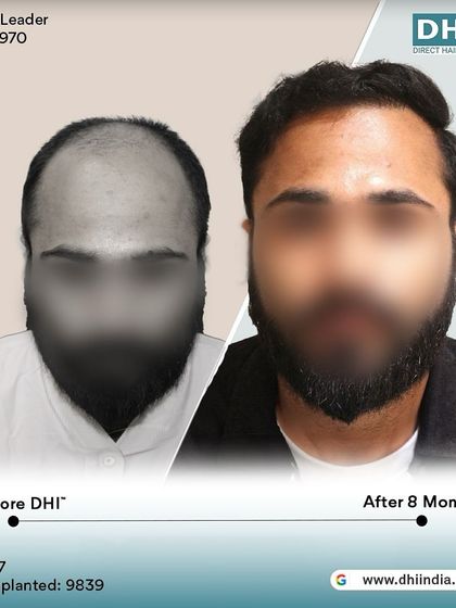 A before and after of a 27-year-old client 8 months post-procedure. With an impressive 9,839 hairs implanted, his hair is now incredibly dense and his hairline is perfectly restored.