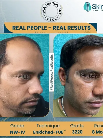 This is a clear example of a corrective hair transplant result after 8 months. The patient's previous transplant left him with a receded and sparse hairline. Using my EnRiched-FUE™ technique, we redesigned the hairline and added 3220 grafts to create the density and natural look he was hoping for.