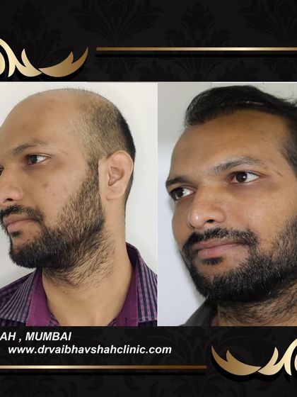 Another angle to appreciate the density and natural appearance of this major restoration.