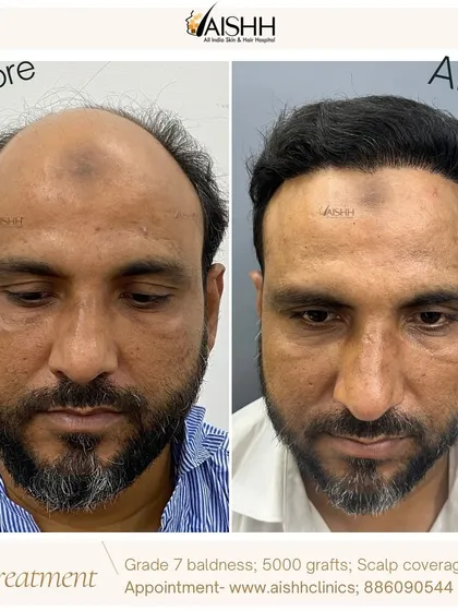 I believe no case is too advanced. This patient came to me with Grade 7 baldness, and using the FUE-DHT technique, we achieved this full-coverage result in just six months. It shows what's possible with the right plan and technology.