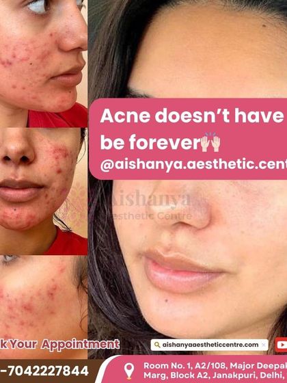 Acne doesn't have to be forever. This collage shows the journey from inflamed, active acne to clear, calm skin. It's a process, but with the right professional guidance, it is absolutely achievable.