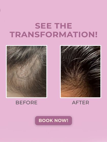 The transformation is clear. This result was achieved through our advanced GFC/PRP treatment combined with a derma pen, which enhances the delivery of growth factors to the hair roots for improved hair revival.
