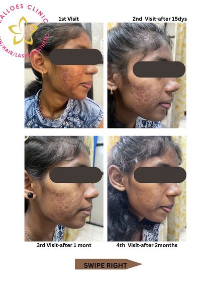 A side profile view of the same teen patient, showing the reduction in inflamed acne lesions and post-inflammatory marks. This highlights the importance of a correct diagnosis and avoiding unsuitable products, especially on sensitive teen skin.