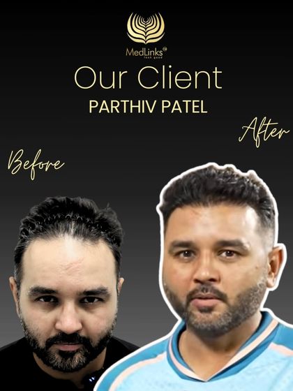 Another champion's comeback. Cricketer Parthiv Patel's before and after transformation showcases the natural and dense result we aim for with every patient.
