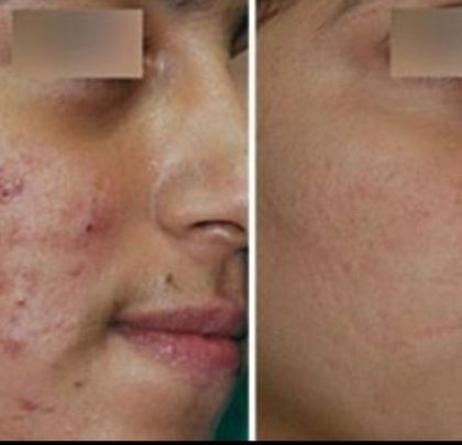This patient's journey involved treating both active acne and resulting hyperpigmentation. The 'after' image shows a calmer, more even-toned complexion, achieved through a combination of medical treatments and peels.