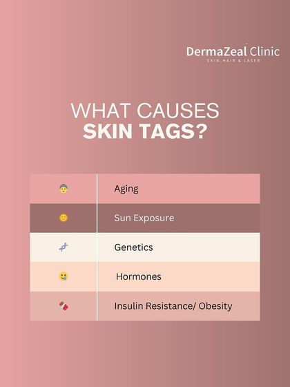 This graphic explains what causes skin tags. Factors can include aging, sun exposure, genetics, hormones, and insulin resistance. Regardless of the cause, they can be safely removed.