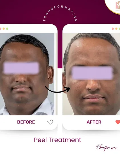 Real results speak for themselves. This is a transformation achieved with a customized chemical peel treatment plan designed to address specific skin concerns, revealing a brighter, more even-toned complexion underneath.