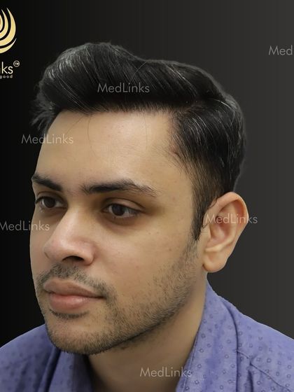 The final result from the side, showing a natural and dense hairline.