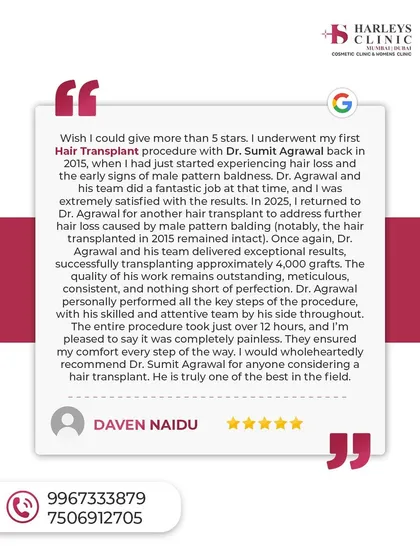 This review from a patient I treated in 2015 and again in 2025 highlights my commitment to long-term results and patient care. He notes that the hair from his first transplant remained intact a decade later, a testament to the permanence of the FUE technique when done correctly.