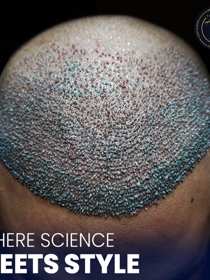 This angle shows how we blend the transplanted area with existing hair. The goal is a seamless transition, ensuring that once the hair grows, no one can tell a procedure was done.