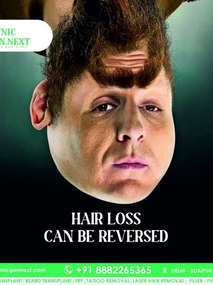 Hair loss can be reversed. With the right technique and an experienced surgeon, you can get your hair back.