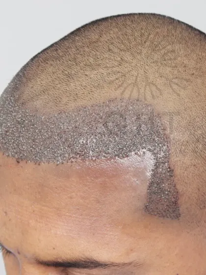 Fresh graft placement for a Grade 2 case. We used 2400 grafts to recreate the hairline, enhance the frontal region, and design natural temples.