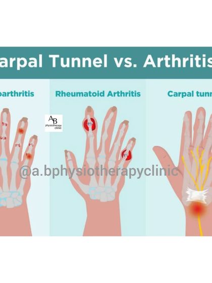 This visual guide compares the pain patterns of Osteoarthritis, Rheumatoid Arthritis, and Carpal Tunnel Syndrome in the hand. A correct diagnosis is key to effective treatment.
