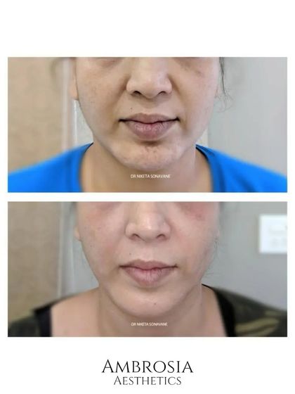 This before-and-after demonstrates a subtle liquid facelift effect. By adding volume with dermal fillers to key areas like the cheeks and softening smile lines, the entire mid-face appears lifted and more youthful.