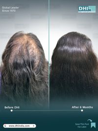 Hair Transplant Surgery