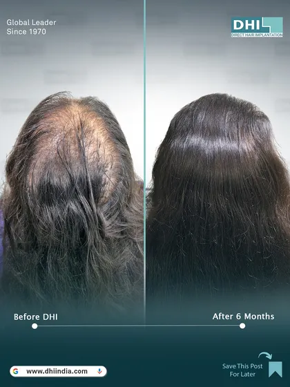 A rear view of the 6-month transformation, showing excellent coverage and a fuller appearance. Our technique ensures a natural look from every angle, without shaving the head.