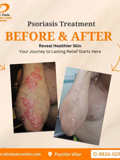 (Hero Media) This is a powerful example of how a targeted treatment plan can manage a chronic condition like psoriasis. The image on the left shows the inflamed, scaly plaques on the patient's arm before treatment, and the right shows the same arm with clear, healthy-looking skin after a course of therapy, providing significant relief from discomfort.