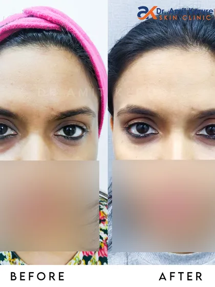Here you can see the immediate effect of tear trough fillers. This non-surgical treatment restores volume under the eyes, significantly reducing the appearance of hollows and dark circles for a refreshed, well-rested look.