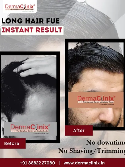 This is our Long Hair FUE technique, which we call Instagraft. It allows for a complete hair transplant with absolutely no shaving or trimming and zero downtime. The patient walks out with instant coverage, making it a discreet and convenient option.
