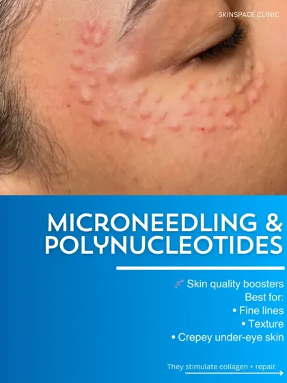 To improve the quality of thin, crepey under-eye skin, we use skin quality boosters like Microneedling and Polynucleotides. These treatments are best for stimulating collagen and repairing texture to smooth fine lines.